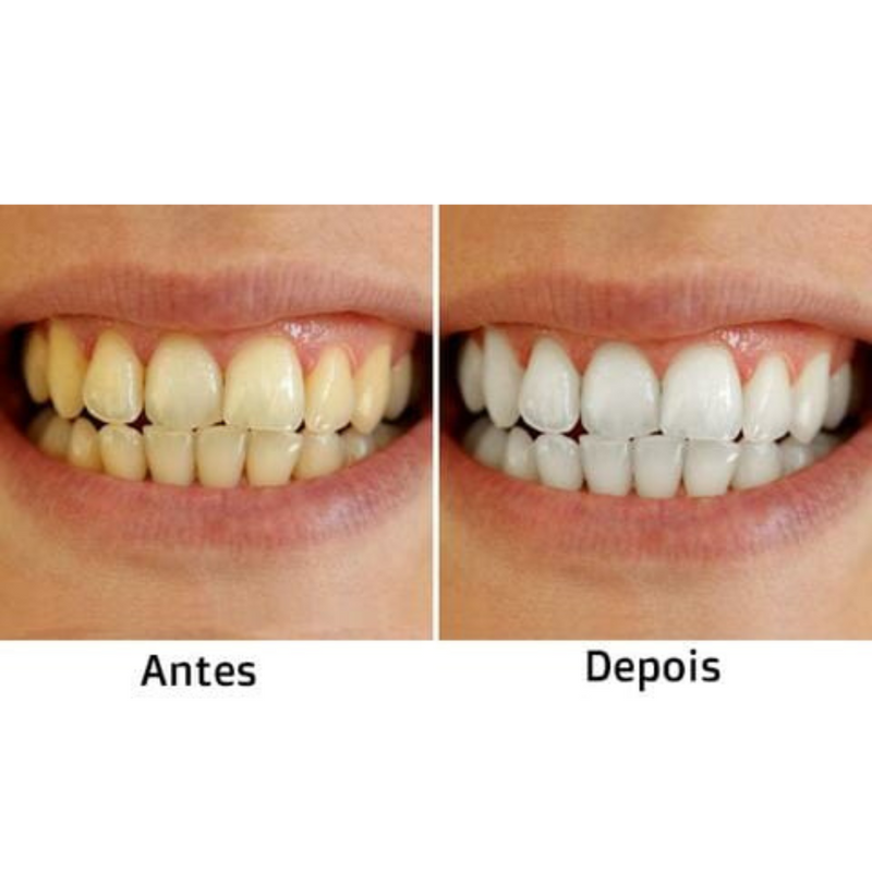 Kit Completo para Clareamento Dental - Dentes mais brancos sem Sensibilidade